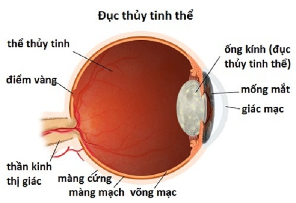 Bệnh về mắt thường gặp ở người già