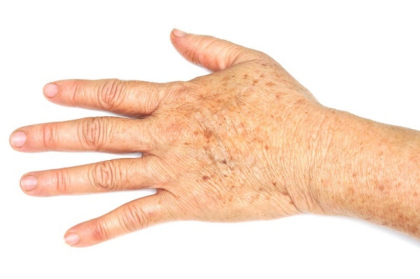 Bệnh về da thường gặp ở người cao tuổi